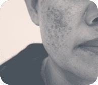 Service Offered: Melasma